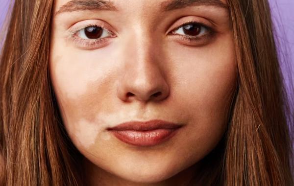 برای درمان لک های سفید پوستی چه روش هایی وجود دارد؟