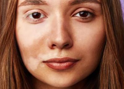 برای درمان لک های سفید پوستی چه روش هایی وجود دارد؟